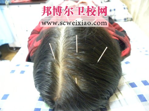 如何利用針灸治療偏頭痛