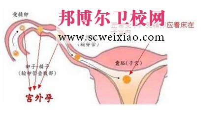 護(hù)士資格考試之宮外孕考點(diǎn)內(nèi)容