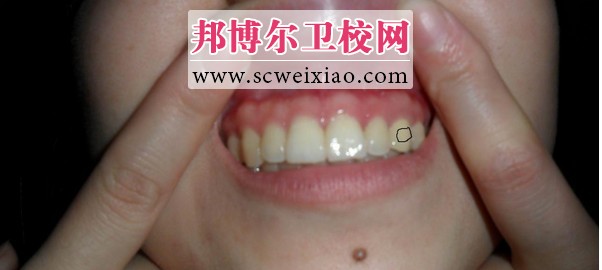 5種狀況可選烤瓷牙恢復(fù)牙齒形象