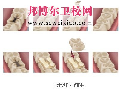 哪些情況下需要補(bǔ)牙